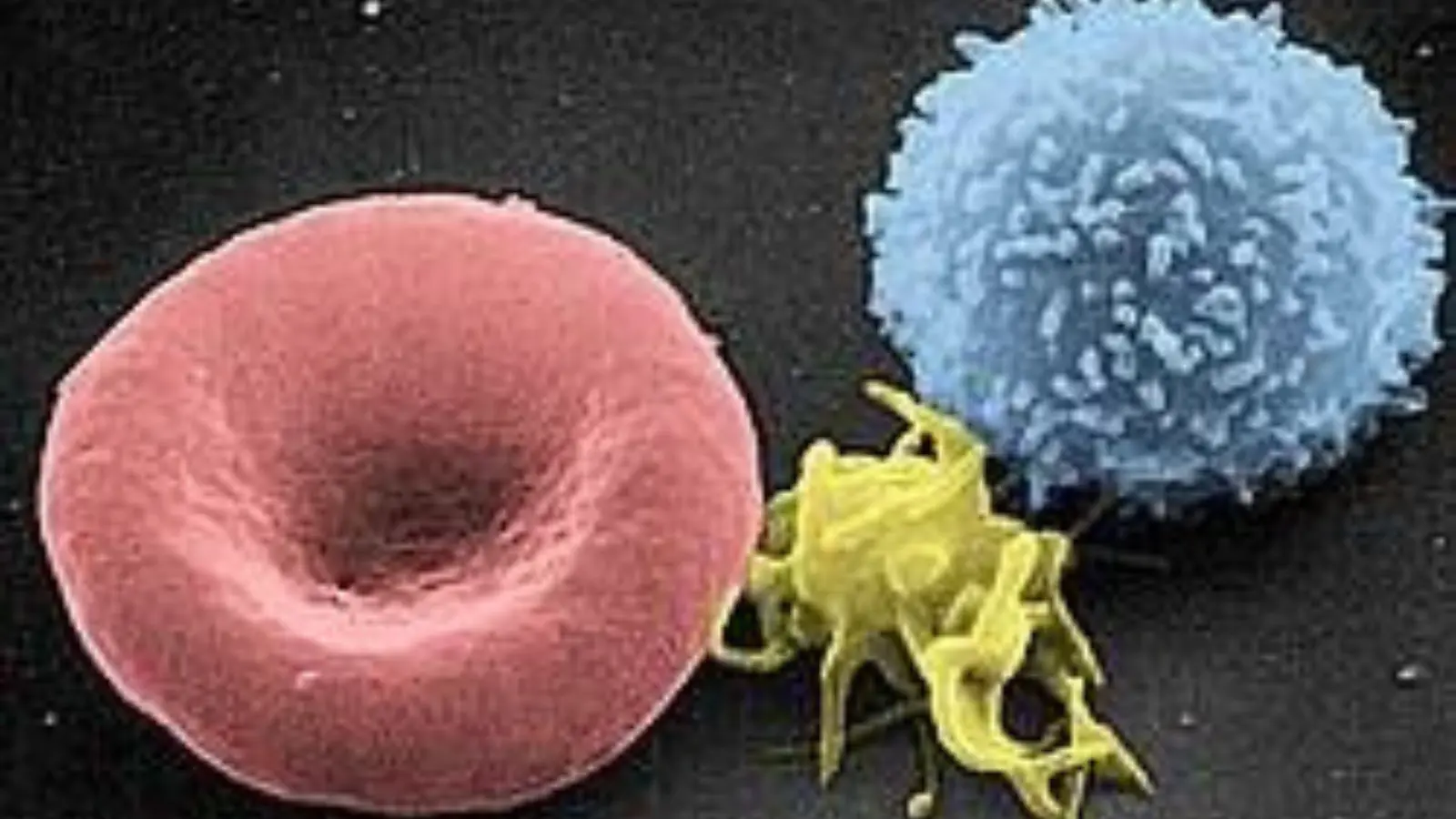 mean platelet volume high